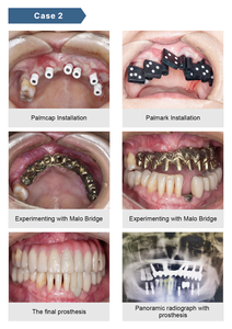 Pemindai Ekstraoral untuk Alur Kerja <span class=keywords><strong>Digital</strong></span> untuk Posisi Multi-implan - Product Image 6