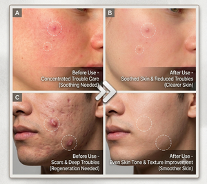 Reusoul Hydrocolloid Collagen Blemish AC Cica Spot Cover Patches Traitement des Imperfections Patch Hydrogel Forme Circulaire 41 Patchs Tous Types de Peau - Product Image 2