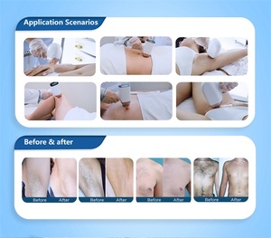 ADSS 핫 아이스 다이오드 콰트로 플래티넘 4 웨이브 808nm 다이오드 레이저 제모 기계