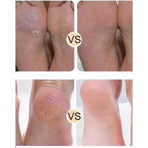 Appareil électrique professionnel pour éliminer les callosités des pieds, batterie rechargeable pour des talons lisses et doux - Qualité durable de classe A+ SHEARS BEAUTY - Product Image 5