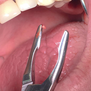 Rongeur chirurgical orthopédique pour la coupe et la précision des tissus, 7 pouces, corps arrondi, pointe incurvée et robuste, double ressort - Product Image 6