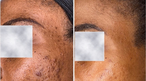 Elions Cosmeceuticals OEM 30% Prime Skin Peel Serum para Eliminar Cicatrices y Estrías, Blanqueamiento para Personas de Piel Oscura, Uso Profesional, Peeling - Product Image 4