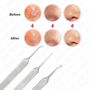 ชุดแหนบกำจัดสิวเสี้ยนสแตนเลสอย่างดี สำหรับดูแลรูขุมขนและผิวหน้า - Product Image 6