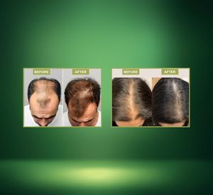 โชฮัน ออล เนเชอรัล แฮร์ โทนิค เซรั่มบำรุงเส้นผมและกระตุ้นการเจริญเติบโตของเส้นผม - Product Image 3