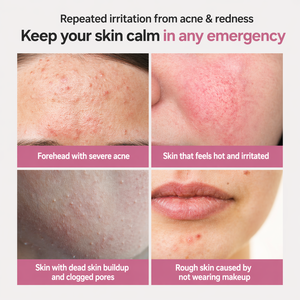 Espuma Limpiadora Facial Suave para el Acné con Ácido Salicílico, Cuidado de los Poros, Control de Sebo, Hidratante, Equilibrio de la Piel - Product Image 2