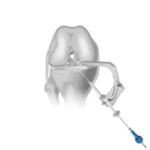 ดอกสว่านออร์โธปิดิกส์รุ่นใหม่ ดอกสว่านแบบเรโทร สแตนเลสสตีล อุปกรณ์ผ่าตัดออร์โธปิดิกส์ที่จำเป็น ผลิตโดย Medzora Surgical - Product Image 4