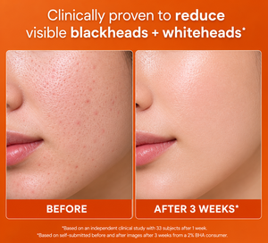OEM/ODM 2% BHA <b>Liquid</b> Exfoliant Salicylic Acid Smooth Even Skin Tone Unclogs Shrinks Pores Private Label at Wholesale Price - Product Image 5