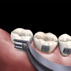 Pinzas para Tubos Bucales Delgados, Instrumento Dental de Ortodoncia, Herramienta de Colocación de Precisión, Acero Inoxidable, Uso Profesional en Clínicas - Product Image 1