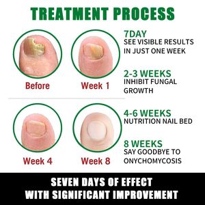 Ginger Soft Nail Shine Moisturizer para el Cuidado de Manos y Pies, Solución para el Cuidado de Uñas Grises - Product Image 5