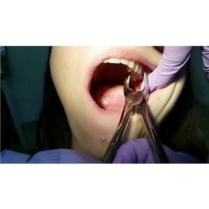 Kit de forceps d'extraction GDC de qualité supérieure avec plusieurs types de forceps pour la chirurgie buccale, disponible à un prix compétitif - Product Image 2