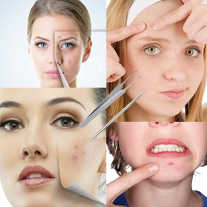 Pinzas para Puntos Negros, Extractor de Puntos Negros y Espinillas, Pinzas Curvas para Eliminar Puntos Negros y Espinillas - Product Image 3