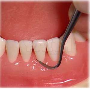 Détartreurs dentaires personnalisés, légers et les plus vendus – Offre spéciale sur les détartreurs dentaires médicaux - Product Image 5