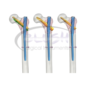 Stock Orthopedic Surgical Humeral Nail for Osteoporotic Bone Fixation Medical Orthopedic By <b>Blush</b> Surgical - Product Image 1