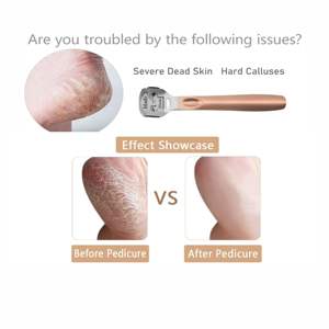 Removedor de Callosidades para Pies, Lima para Pies de Acero Inoxidable y Plástico Resistente con Borde Afilado, Raspador Profesional para Piel Dura y Talones Agrietados - Product Image 3