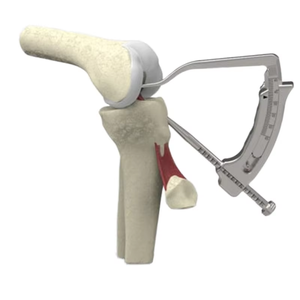 Best Price Manual Stainless Steel ACL/PCL Reconstruction All-in Cruciate Ligament Instrument Set CE Approved By <b>Blush</b> Surgical - Product Image 6