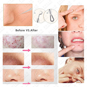 ชุดเครื่องมือสกัดสิว 5 ชิ้น ระดับมืออาชีพ ทำจากสแตนเลส สำหรับกำจัดสิวเสี้ยน ดูแลผิวหน้า - Product Image 3