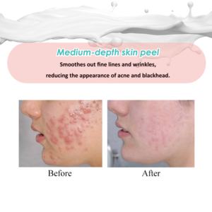 Private Label 14% Acne Peeling Solution Milk Acid Salix Acid Blackhead Pimple Skin Serum - Product Image 2