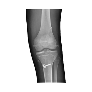 Arandela SPIKE de perfil bajo Tornillo esponjoso ACLPCL Reconstrucción Implante ortopédico para artroscopia de rodilla Suministro sanitario - Product Image 4