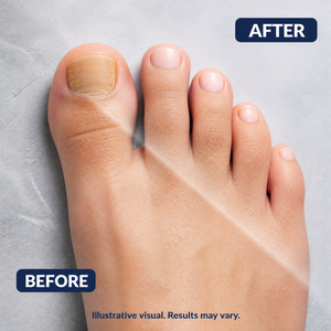 Solution Réparatrice pour Ongles Fongiques 25% Acide Undécylénique Huile d'Arbre à Thé Gouttes Anti-Fongiques Traitement des Ongles des Pieds 2 Flacons avec Lime - Product Image 6