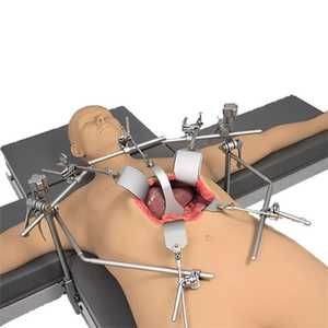 Sistema de Retractores Thompson Avanzado, Juego de Retractores Quirúrgicos Autoestables para Cirugía Abdominal, Ortopédica y de Columna Vertebral - Product Image 3