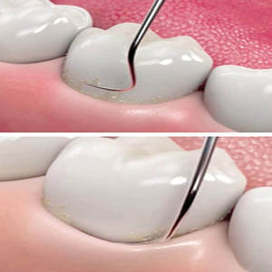 Kit de 8 instruments dentaires pour le soin des dents, comprenant détartreur, gratte-dents et miroir, pour l'élimination du tartre, du calcul et de la plaque dentaire, par Grip Surgical - Product Image 5