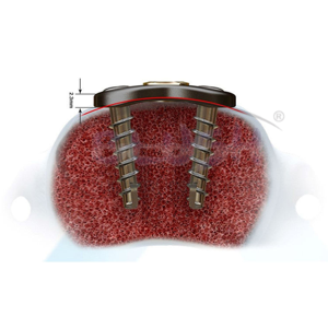 Precio de fábrica: Juego de instrumentos quirúrgicos espinales de acero inoxidable de alta calidad con tornillo pedicular manual de 5.5 mm para Pakistán - Product Image 2