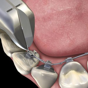 Lingual Pin and Ligature Cutter Orthodontic Dental Instrument Stainless Steel Precision Cutting <b>Pliers</b> Professional Use - Product Image 1