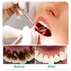 Kit de Examen Dental Desechable con Espejo Bucal, Pinzas y Sonda - Herramientas Manuales de Cuidado Bucal Clase I - Product Image 2