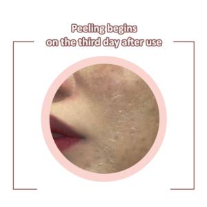 14% Acne Peeling Solution Milk Acid Salix Acid Blackhead Pimple Skin Serum - Product Image 3