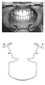 Dental Implant Lip Cheek Retractor Orthodontic Stainless Instruments Intelligent Surgical Robot Mouth Opener By <b>Blush</b> Surgical - Product Image 5