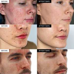 Crème de nuit IVOSKIN Centella Peptide Panthenol Acide Hyaluronique Élimination de l'acné Soin hydratant intensif Anti-rougeurs Nourrissant - Product Image 3