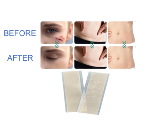 얼굴을위한 맞춤형 인쇄 테이프 시트 흉터 패치 최고의 흉터 고약 방수 흉터 제거 시트 - Product Image 4