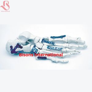 ชุดเครื่องมือผ่าตัดกระดูกข้อเท้าและเท้าแบบไทเทเนียมสำหรับขายส่ง สำหรับการผ่าตัดกระดูกและข้อและศัลยกรรมกระดูกหัก - Product Image 6