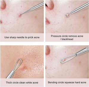 Kit d'extraction de comédons 4-en-1 UBI en acier inoxydable avec aiguilles et embouts de précision pour le nettoyage des pores, points noirs et points blancs du visage - Product Image 2