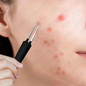 Herramientas para extraer puntos negros y espinillas, kit de herramientas para extraer puntos negros de la cara y la nariz, extractor de acné facial. - Product Image 6