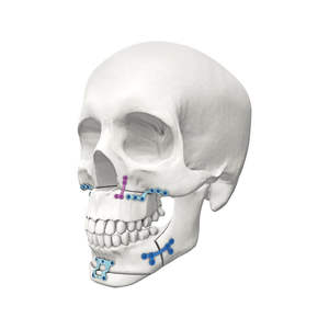 Placa de trauma maxilofacial microrecta para implantes, 0.6mm de grosor, con tornillos de 1.5mm para mini placa ósea de cráneo - Product Image 3