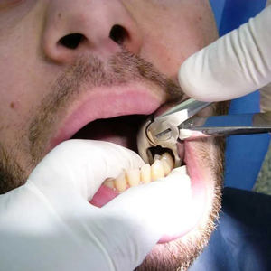 Offre Spéciale : Lot de 10 Pinces d'Extraction Dentaire Manuelles en Acier Inoxydable – Instruments Professionnels pour l'Extraction des Dents d'Adultes - Product Image 5