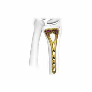 Placa de Bloqueo Volar para Radio Distal de 2.4mm, Implante de Titanio Reutilizable para Fijación de Fracturas Ortopédicas - Product Image 1