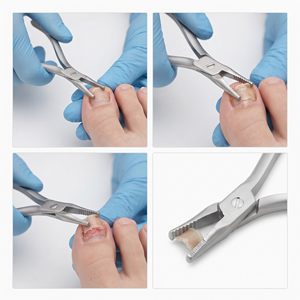 คีมถอนเล็บ สแตนเลสสตีล เครื่องมือผ่าตัดกระดูกและข้อ ปากคีบตรงแบบหยัก - Product Image 3