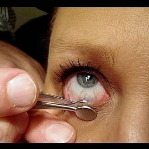 คู่มือการใช้เครื่องมือผ่าตัดจักษุวิทยา 3.5 นิ้ว รุ่น Desmarres & Lambert Chalazion Forceps ทำจากสแตนเลส - Product Image 4