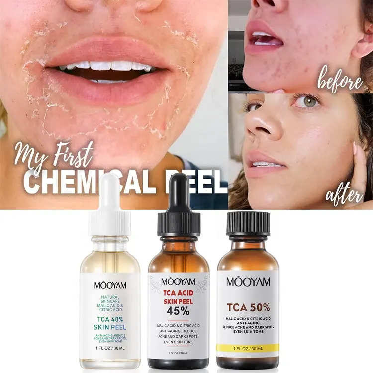 Private Label Skin TCA 40% 45% 50% Chemical Peel Profession elles chemisches Peel-Serum für Haut entferner für dunkle Flecken