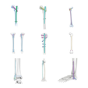 Impianto Ortopedico Chirurgico: Chiodo Intramidollare in Lega di Titanio Certificato CE ISO per Sistema di Fissazione Traumatologica - Product Image 1