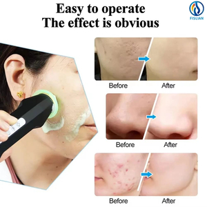 ערכת מתנה חדישה - עט חמצן הידרה לטיפול עור, בועות חמצן יעילות להלבנה, קפסולות חמצן CO2 לטיפולי פנים - Product Image 5