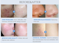 Machine d'épluchage au diamant 12 en 1, hydrodermabrasion à Jet d'eau, Dermabrasion faciale, rajeunissement de la peau, Machine de beauté CE