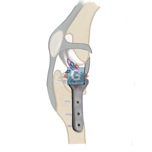 Plaque de fixation chirurgicale vétérinaire manuelle ALPS T en titane 3,5 mm - Product Image 5