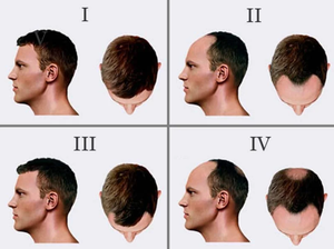 GH-M13 Prótesis Capilar Masculina de Cabello Remy Indio, Ondulado Profundo y Liso, 6 Pulgadas de Largo, Base Mono, Cierre Frontal de Encaje, Nudos Invisibles - Product Image 6