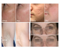 Machine verticale d'épilation permanente d'E-lumière de IPL de machine de beauté de laser d'énergie forte d'ADSS