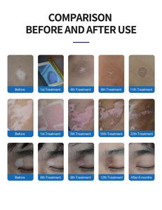 Système Excimer Taibo Laser 308nm, appareil de traitement du vitiligo par la lumière Excimer, machine pour les <span class=keywords><strong>taches</strong></span> <span class=keywords><strong>blanches</strong></span> et la mélanine cutanée - Product Image 5