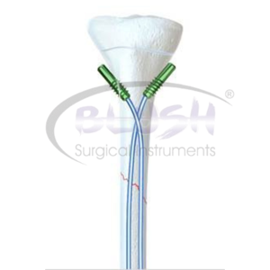 Children's Titanium Alloy Nail Orthopedic Interlocking Intramedullary Femoral Elastic Nail By <b>Blush</b> Surgical - Product Image 5