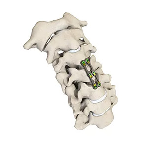 Ensemble d'implants de fixation chirurgicale de la colonne vertébrale, composants en titane, vis pédiaculaires, tiges, crochets, connecteurs, équipement orthopédique - Product Image 2